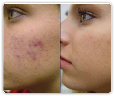 acne_treatment_img