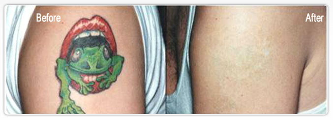 Best Skin Doctor in Delhi for tattoo removal at low cost