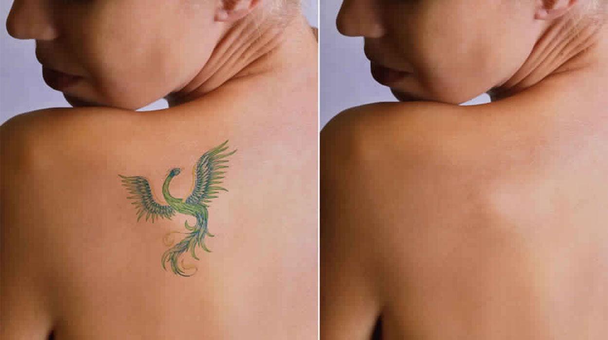 Laser Tattoo Removal ParsippanyTroy Hills  Weinstein Plastic Surgery