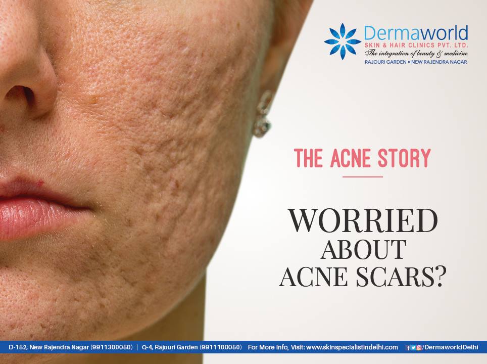 Causes And How To Get Rid Of Acne Scars A Video By Dr Rohit Batra