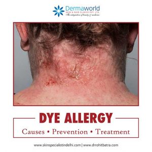 Hair Dye Allergy Treatment, Causes & Prevention | DermaWorld Skin Clinic