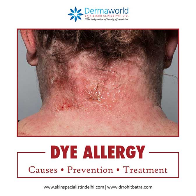 Hair Dye Allergy Treatment Causes Prevention Dermaworld Skin Clinic