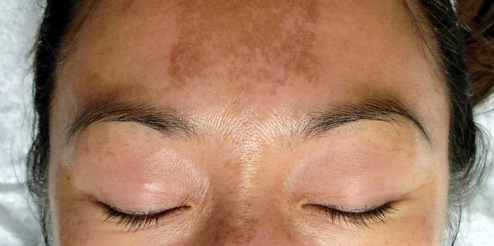 All You Need To Know About Melasma From An Expert Dermatologist