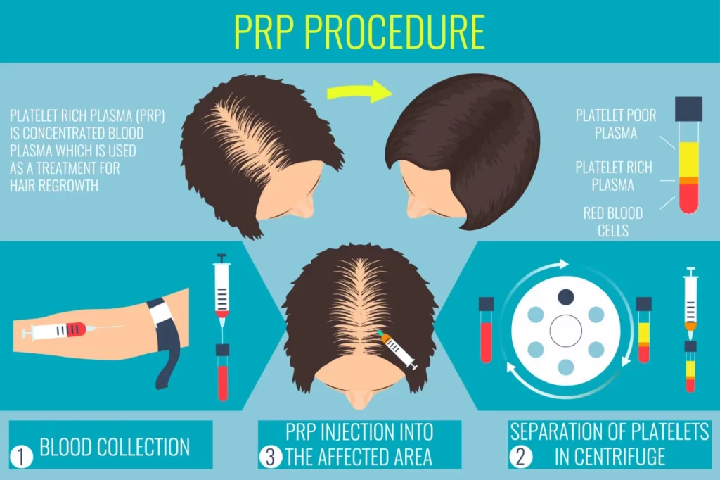 Complete PRP Procedure to Treat Hair Loss & Hair Thinning